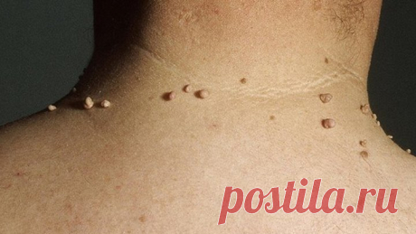 Как избавится от папилом