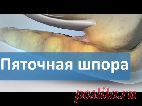 Пяточная шпора. Вопрос-ответ. Московские центры Дикуля о пяточной шпоре.