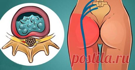 Всего 1 упражнение, чтобы избавиться от болей в спине и успокоить седалищный нерв