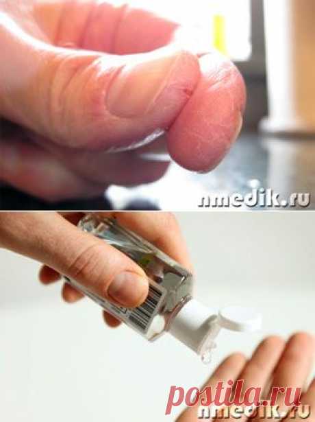 КАК ВЫЛЕЧИТЬ ТРЕЩИНЫ НА ПАЛЬЦАХ РУК