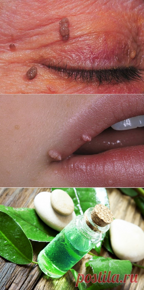 Папилломы на лице: как вывести такие бородавки?