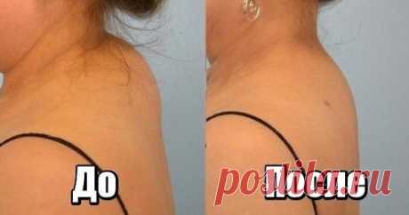 Как убрать холку – вдовий горб - в домашних условиях. Это можно сделать с помощью регулярного выполнения специальных упражнений и массажа.