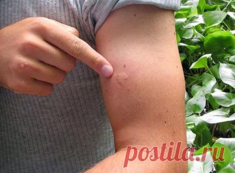 домашнее средство от укусов комаров