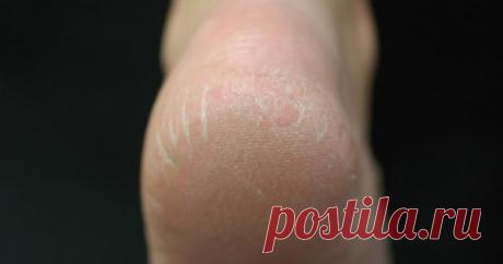 Как избавиться от трещин на пятках