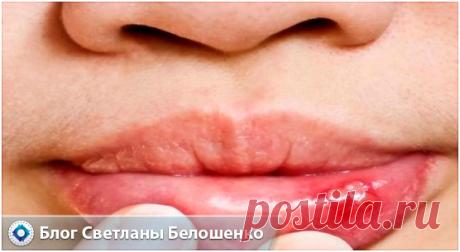 Как лечить герпес на губах в домашних условиях? Если начать лечение простуды вовремя, то можно избежать появления некрасивых болячек, которые сильно зудят и портят внешний вид.
