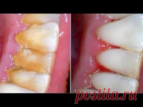 Устраните КАМНИ НА ЗУБАХ за 😉5 мин | Стоматологи ❌НИКОГДА не Скажут об Этих Рецептах