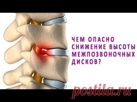 К чему приводит снижение высоты межпозвоночных дисков?