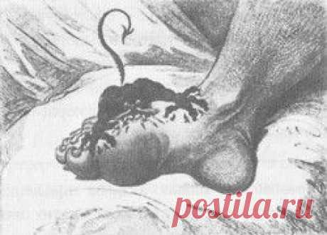 Подагра и мочевая кислота