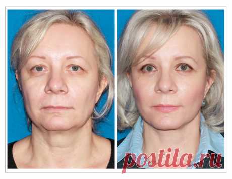 Быстрая подтяжка лица