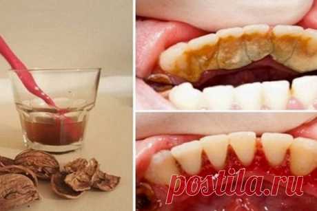 КАК ИЗБАВИТЬСЯ ОТ ЗУБНОГО КАМНЯ ПРИ ПОМОЩИ ОДНОГО ПРОСТОГО СРЕДСТВА – БУДЬ В ТЕМЕ