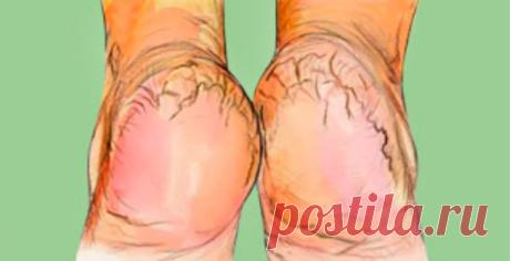 Крем «Безупречные пяточки» приведет в порядок огрубевшую кожу ног! Уже через неделю ваши пяточки забудут о том, что на них были трещины и порадуют вас своим ухоженным видом!