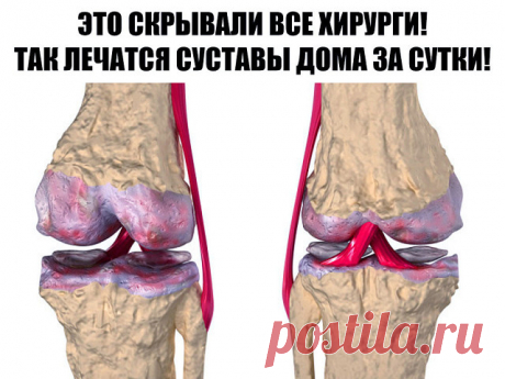 Это скрывали все хирурги! Так лечатся суставы дома за сутки
Эта микстура «скорая помощь» от боли в суставах.
Такая микстура должна быть в каждом доме.
Ингредиенты:
1 сл. ложка крупной соли,
1 литр воды, нашатырный спирт, камфорное масло.
Всыпьте 1 ст. ложку соли крупного помола в 1 л воды и размешайте. Отдельно возьмите 80-100 мл 10 %-го нашатырного спирта и влейте туда 10 г камфорного спирта. Смесь взболтайте и соедините с солевым раствором. Появятся белые хлопья....