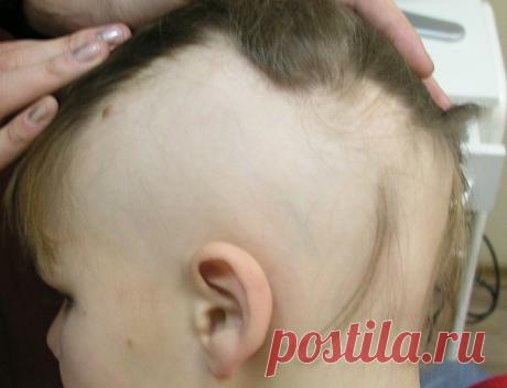 Что делать если у ребенка выпадают волосы в 3 месяца, 2, 4, 5, 7, 10 лет: видео-инструкция по лечению своими руками, почему стали выпадать, причины выпадения, фото и цена