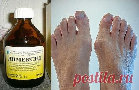 Косточка больше не болит!
Потратила копейки на 2 средства, а эффект невероятен.