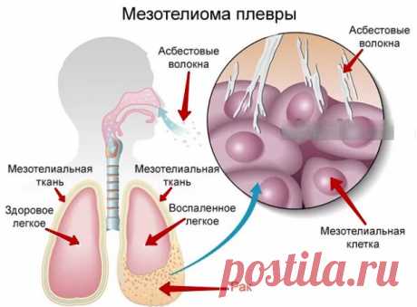 В России используют минерал, запрещённый в 63 странах
Вплоть до 70-х годов прошлого столетия асбест высоко ценился за превосходную теплоустойчивость и способность стоически переносить любые погодные условия. Это волокнистое вещество широко использовали в самых разных областях промышленности: от утепления домов и изготовления крыш до строительства бань. Вот только тогда люди не знали, что окружают...
Читай дальше на сайте. Жми подробнее ➡
