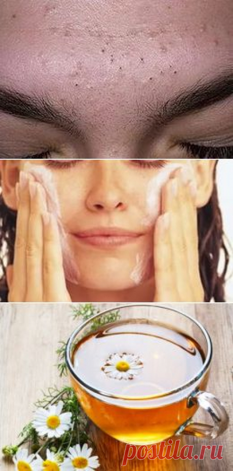 Как почистить лицо от черных точек в домашних условиях
