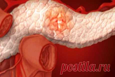 Хронический панкреатит в стадии обострения - симптомы и признаки