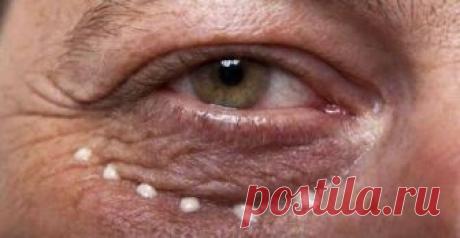 Народные средства от морщин под глазами: Эффект гарантируем! Морщин из-под глаз "сходят" без ботокса! Просто каждое...