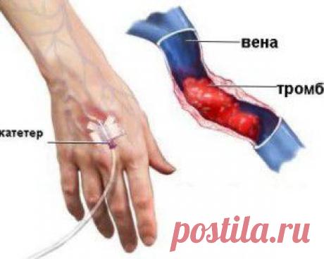 Средства и методы народной медицины в борьбе с тромбофлебитом | Домашний лекарь