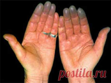 Почему немеют пальцы левой и правой руки - причины и советы