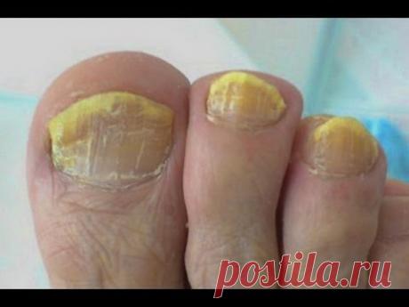 Грибок ногтей | Народное лечение грибка -ноготь грибок - № 1 | #грибокногтей #edblack
