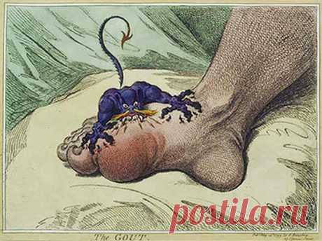 Подагра-болезнь королей или гениев?