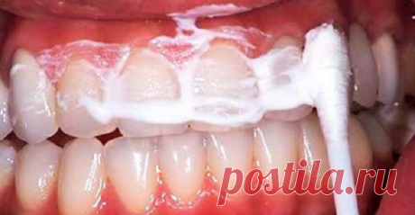 Протрите ваш рот на 60 секунд этой смесью и удалите зубной камень и зубной налет с ваших зубов!