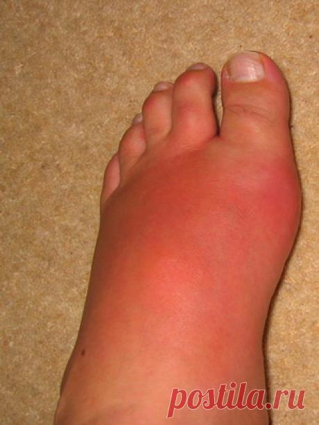 Подагра: фото, народное лечение в домашних условиях, симптомы, как выглядит подагра, народные рецепты