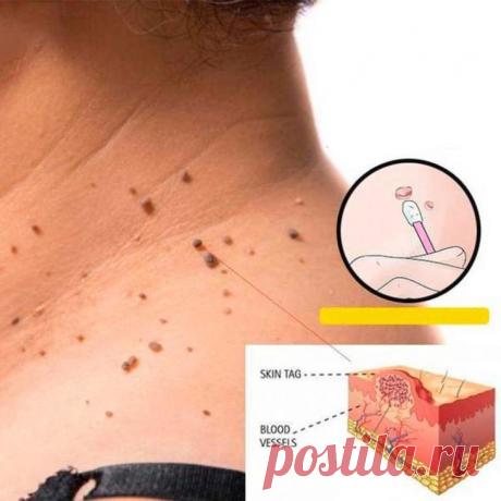 Травы, которые убирают бородавки и папилломы