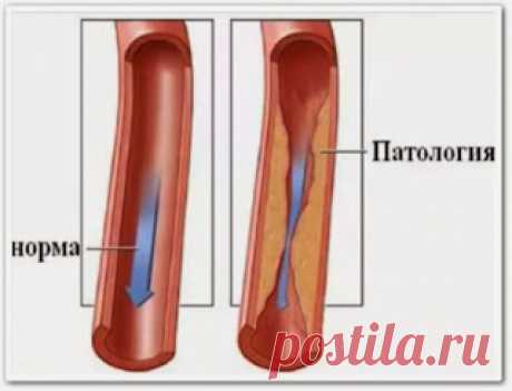 Как вылечить и предупредить атеросклероз (онлайн видео)