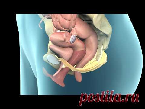 Pelvic Prolapse | Nucleus Health