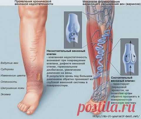 Самый лучший и Эффективный способ лечения ВАРИКОЗА! | Я и Ты