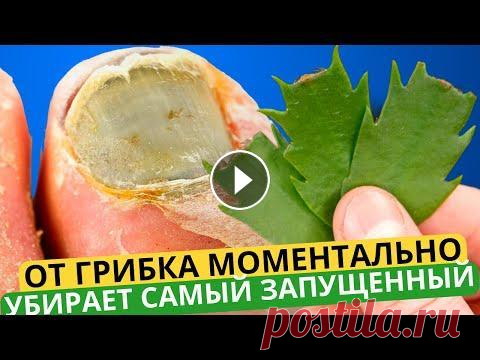 ЧЕРНый НОГОТЬ СЛЕЗЕТ СРАЗУ! Грибок ногтей исчезнет точно сразу благодаря этому простому рецепту! ❗️Включите субтитры и смотрите видео на вашем родном языке!⬆️...