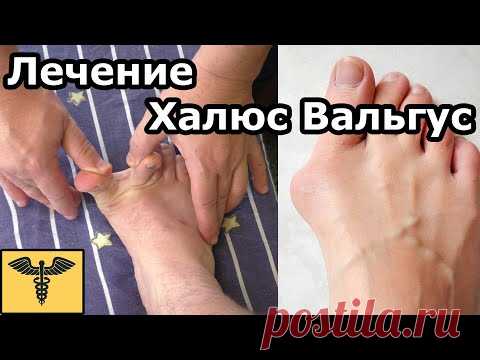 Hallux valgus | Халюс Вальгус | Искривление пальцев ног | Быстрое лечение | доктор Божьев