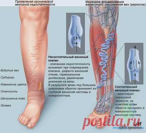 Варикоз и сосудистые "звездочки" на ногах - простое решение проблемы..