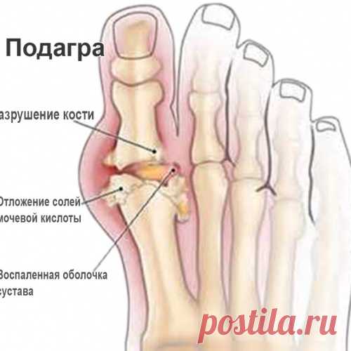ХИЖИНА ЗДОРОВЬЯ. Подагра или наросты на костях