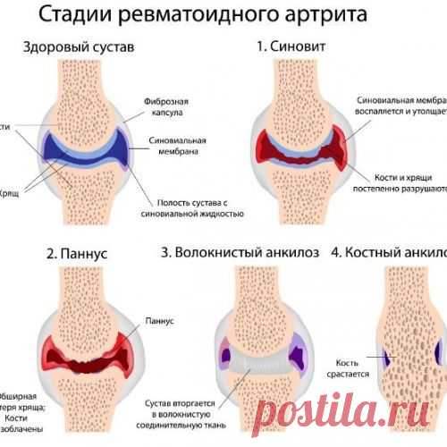 СУПЕРЛЕЧЕНИЕ - КАРТОФЕЛЬ НА КЕФИРЕ ПРОТИВ АРТРИТА