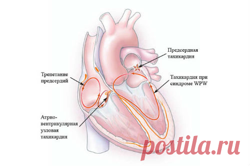 Тахикардия: причины, симптомы и лечение народными средствами - медиаплатформа МирТесен