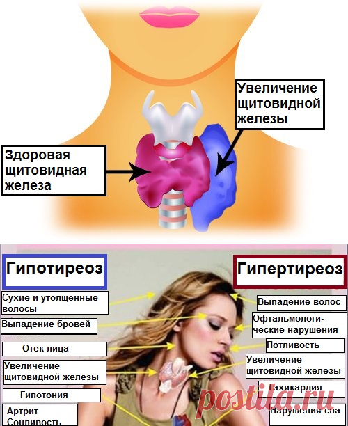 Гипотиреоз недостаток йода. Здоровая щитовидная железа. Гипотиреоз щитовидной железы. Уменьшенная щитовидная железа.
