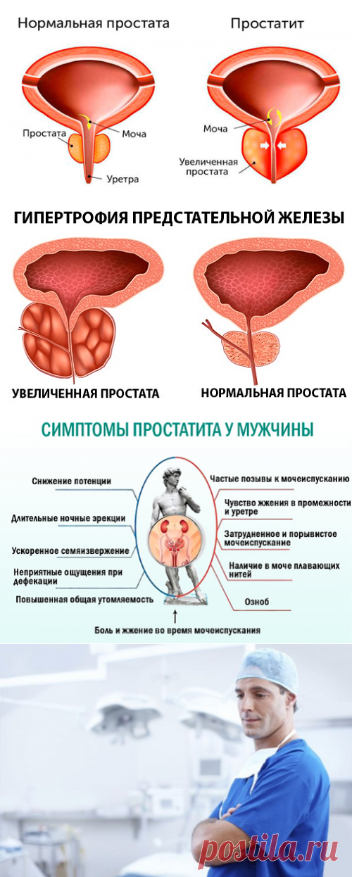 Что такое простата: симптомы и немного полезной информации для мужчин | Кладовая здоровья | Яндекс Дзен