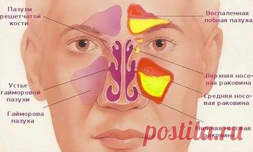 Как очистить гайморовые и лобные пазухи от гноя и слизи