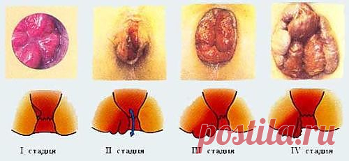 Все стадии лечения геморроя.