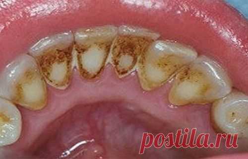 Как удалить зубной налет и позаботиться о здоровье полости рта? - Шаг к Здоровью