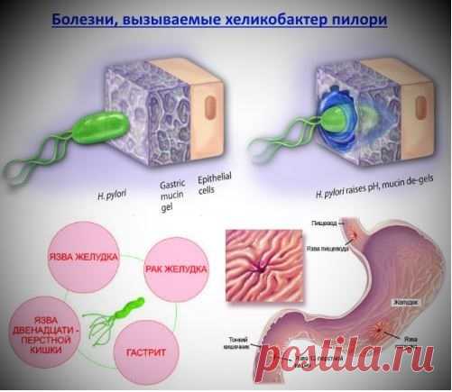 Альтернативное лечение хеликобактера в России - Россия , Москва и Московская обл. , Москва, разместить объявление бесплатно Киев