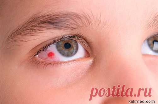 Как укрепить кровеносные сосуды глазного яблока?