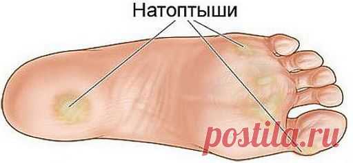 Как быстро вылечить мозоль: несколько простых и эффективных способов