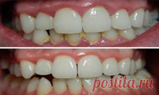 Как удалить зубной налет за 5 минут естественным способом без визита к стоматологу! | Golbis