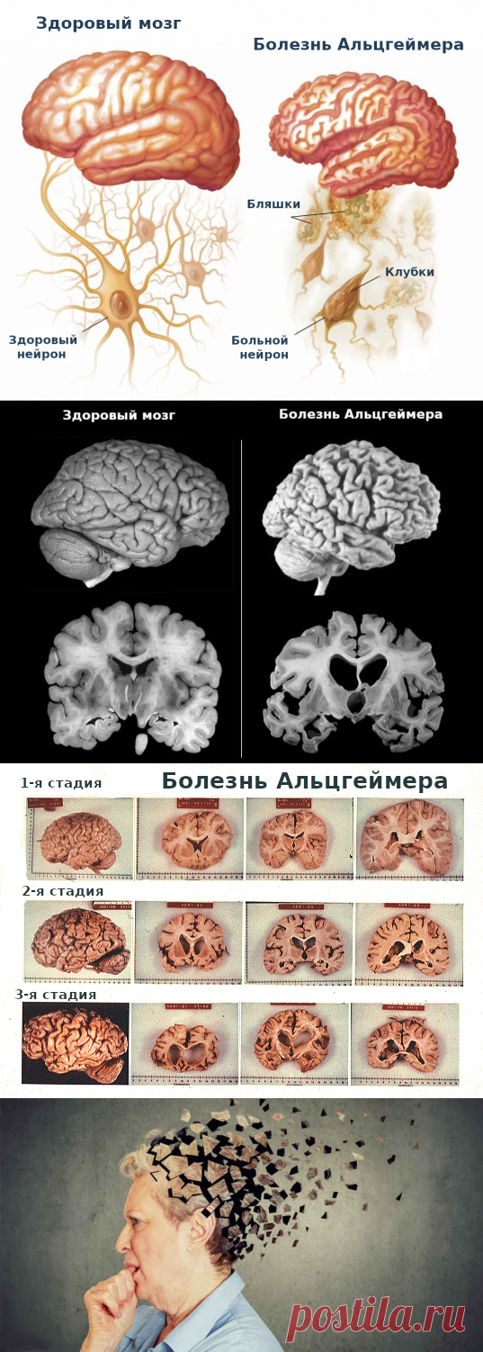 Болезнь Альцгеймера является нейродегенеративной формой деменции, которая вызывает диффузную гибель нейронов по всему мозгу, что приводит к тяжелой дисфункции мозга и смерти. Болезнь Альцгеймера составляет 60–80% всех случаев деменции и включает все случаи деменции с кортикальной атрофией, нейрофибриллярными клубками и сенильными бляшками, независимо от возраста начала болезни.
