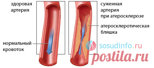 10 продуктов, которые помогут предотвратить блокировку артерий 



Добавьте в рацион!







 


• ЧеснокС древних времен чеснок использовался для лечения заболеваний сердца и гипертонии. Согласно исследованию, опубликованному в журнале превентивной медицины, чес…