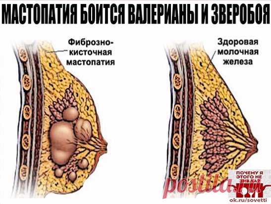 МАСТОПАТИЯ БОИТСЯ ВАЛЕРИАНЫ И ЗВЕРОБОЯ
Услышав от врачей диагноз «мастопатия», многие женщины впадают в отчаяние. И не случайно. Большинство не знает, как это заболевание лечить и как с ним жить. Доктора зачастую никакого лечения не предлагают. Советуют лишь проверять молочные железы каждый год, а вот если уплотнение начнет расти, тогда … придется, видимо, оперировать. Утешение, сами понимаете, слабое. А вот народная медицина знает немало естественных средств, с помощью которых можно облегчить с